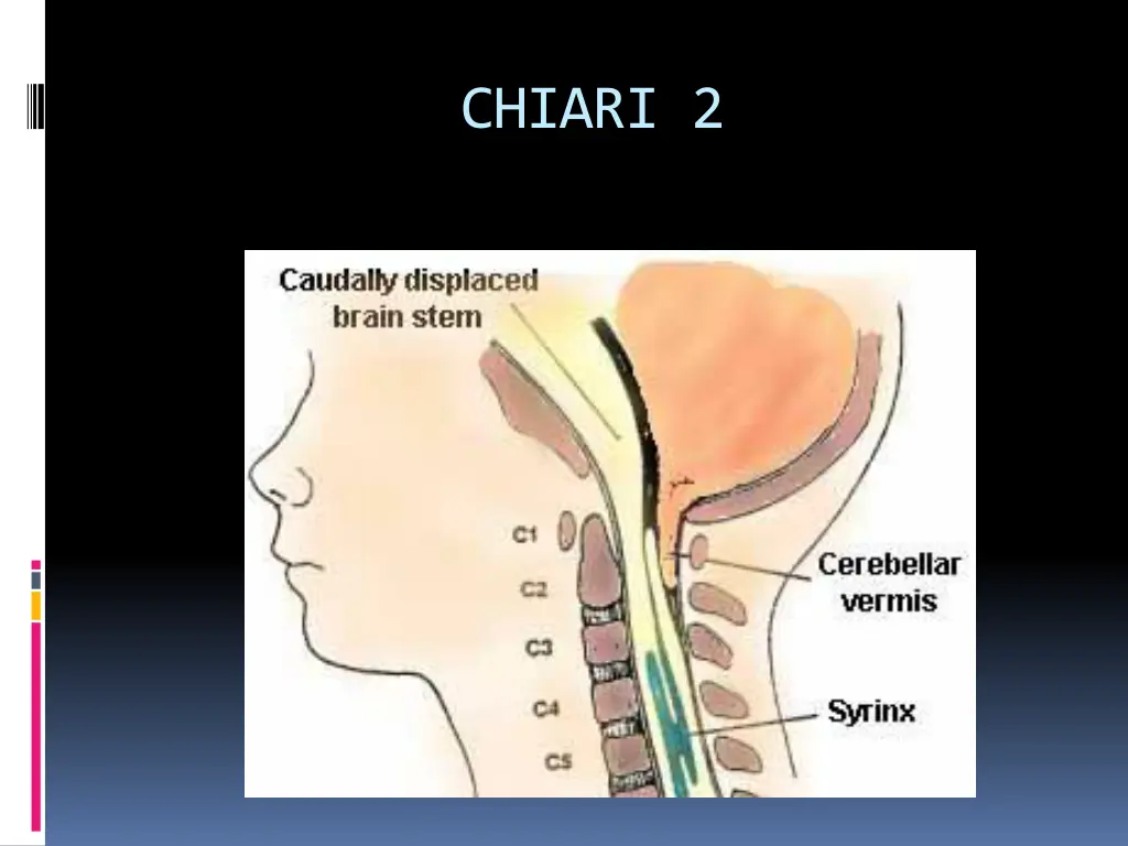 chiari 2 1