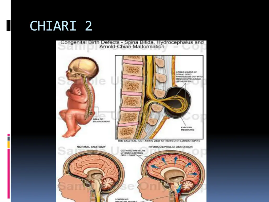 chiari 2