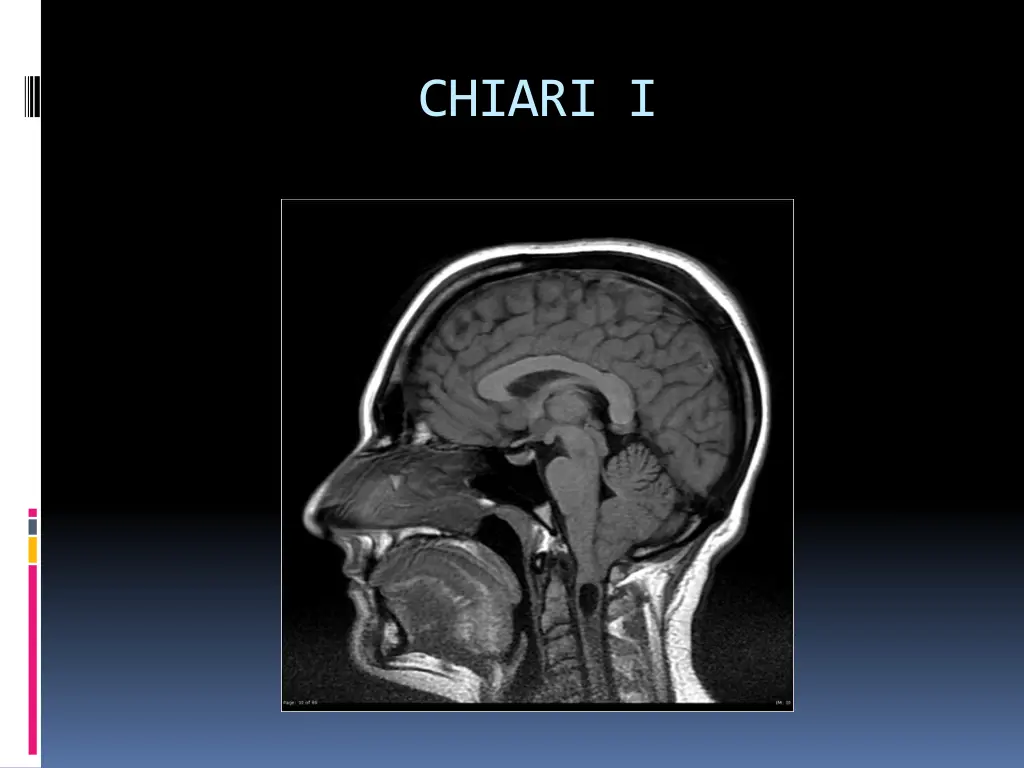 chiari i