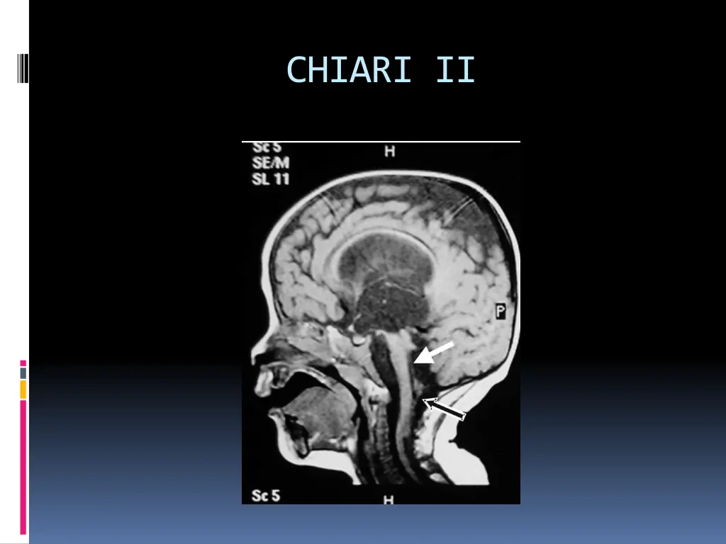 chiari ii 1