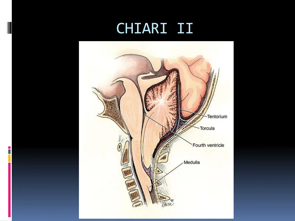 chiari ii