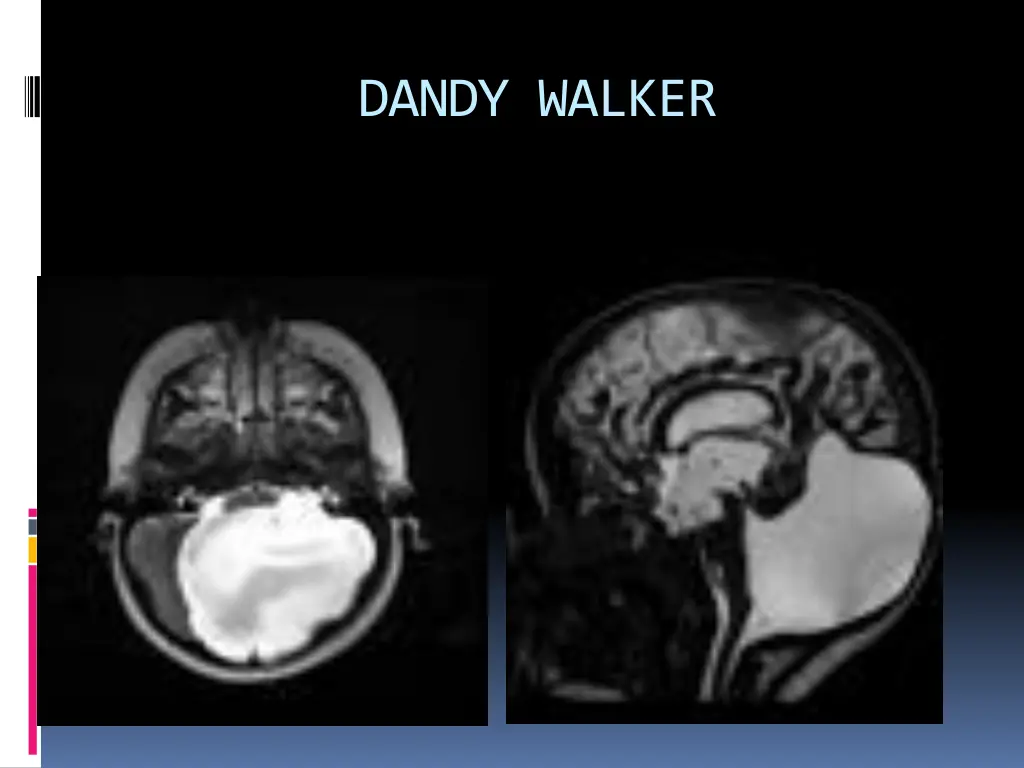 dandy walker 1