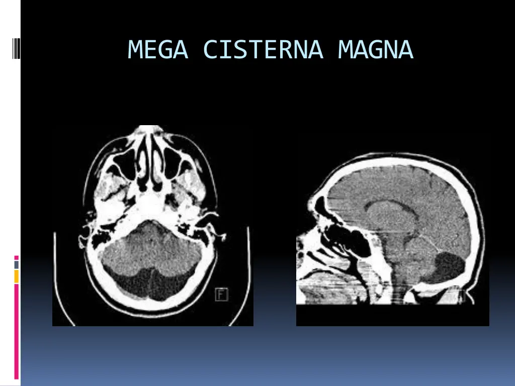 mega cisterna magna 1