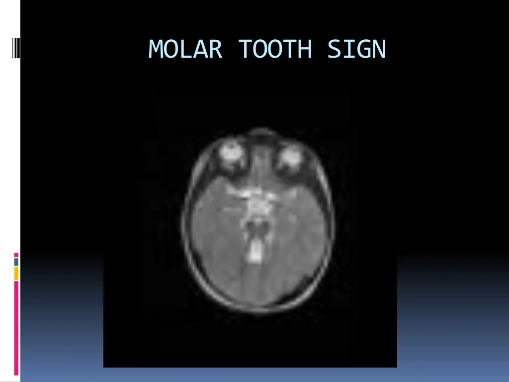 molar tooth sign