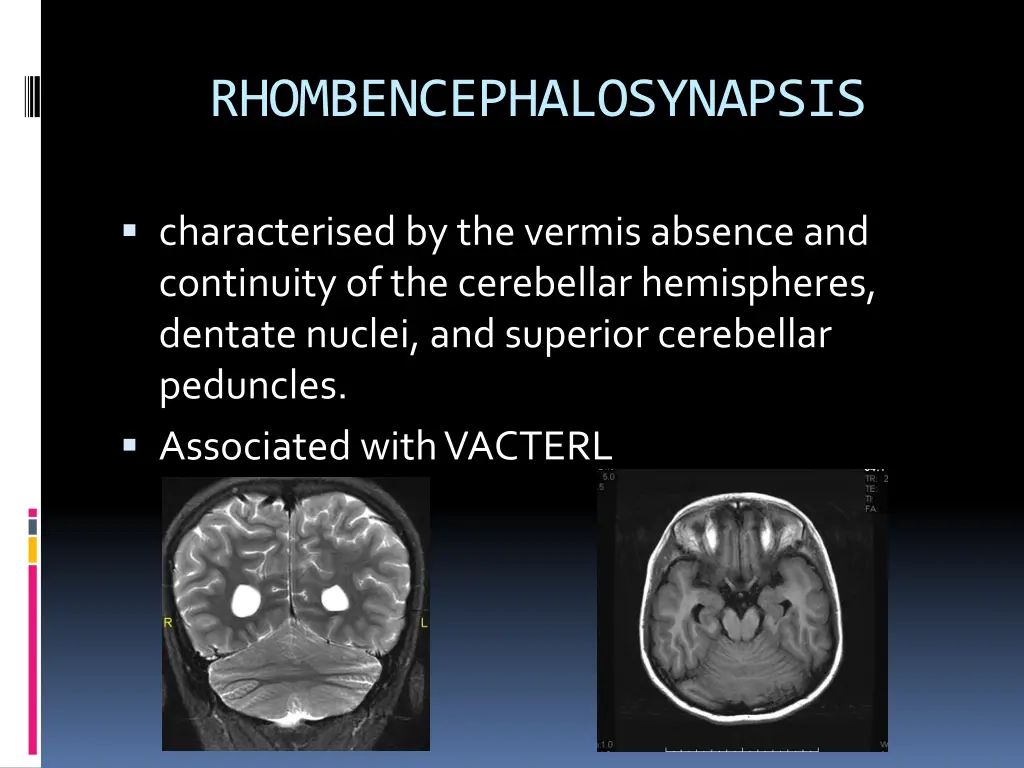 rhombencephalosynapsis