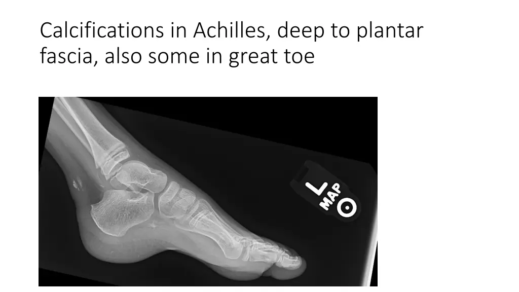 calcifications in achilles deep to plantar fascia