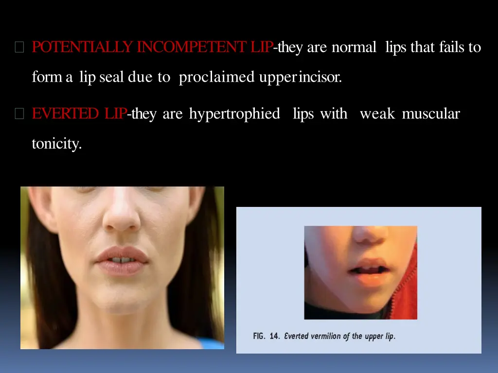 potentiallyincompetent lip they are normal lips