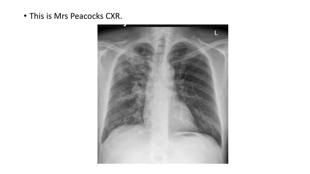 this is mrs peacocks cxr