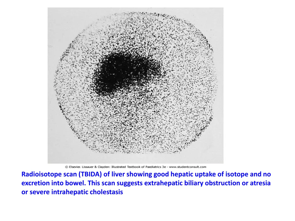 radioisotope scan tbida of liver showing good