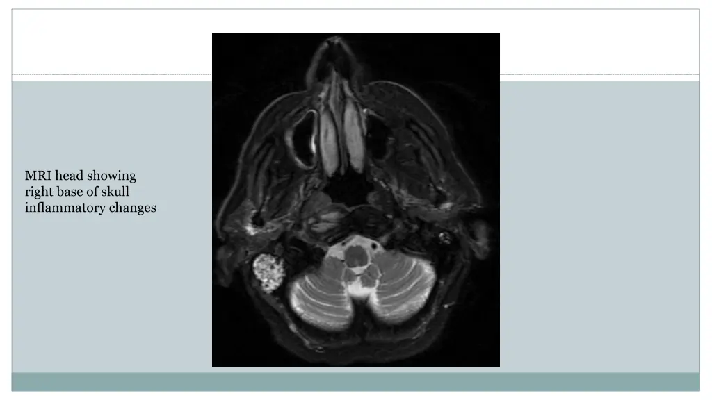 mri head showing right base of skull inflammatory