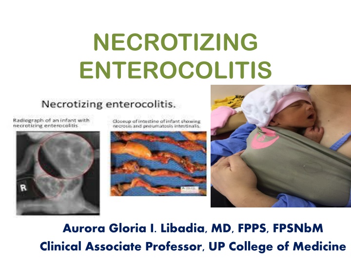 necrotizing enterocolitis