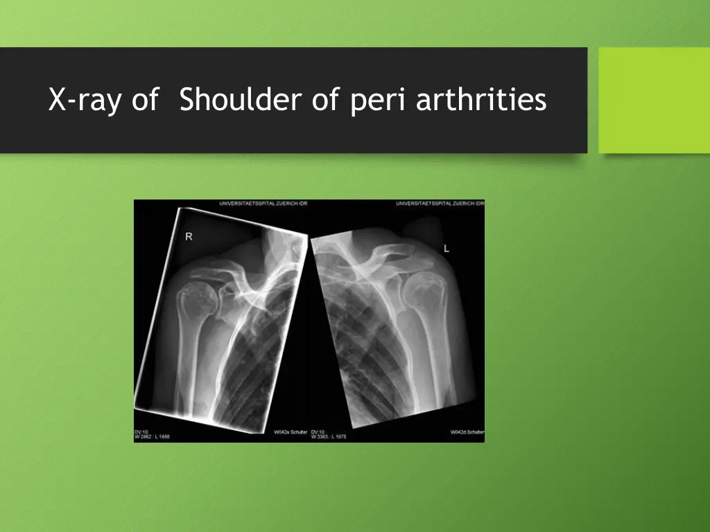 x ray of shoulder of peri arthrities