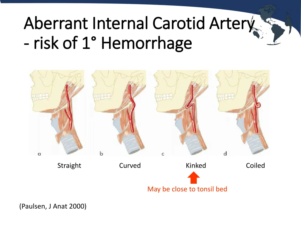 aberrant internal carotid artery aberrant