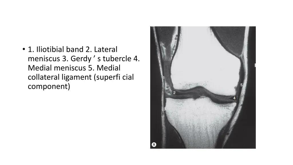 1 iliotibial band 2 lateral meniscus 3 gerdy