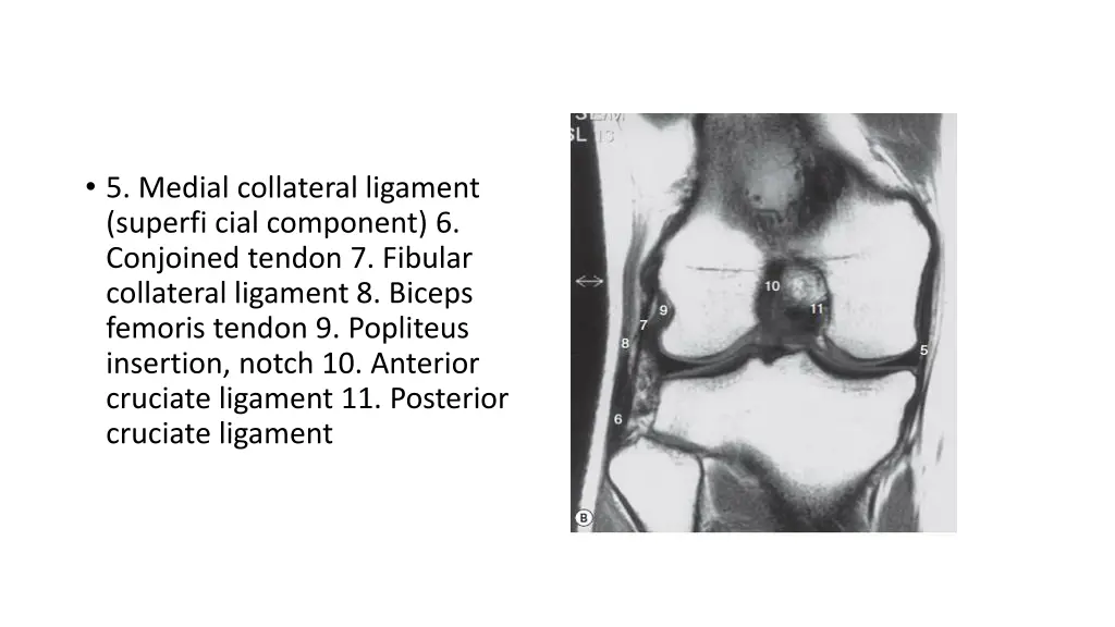 5 medial collateral ligament superfi cial