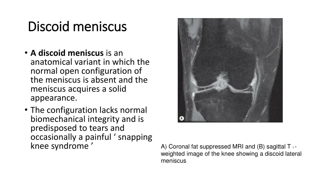 d discoid iscoid meniscus meniscus