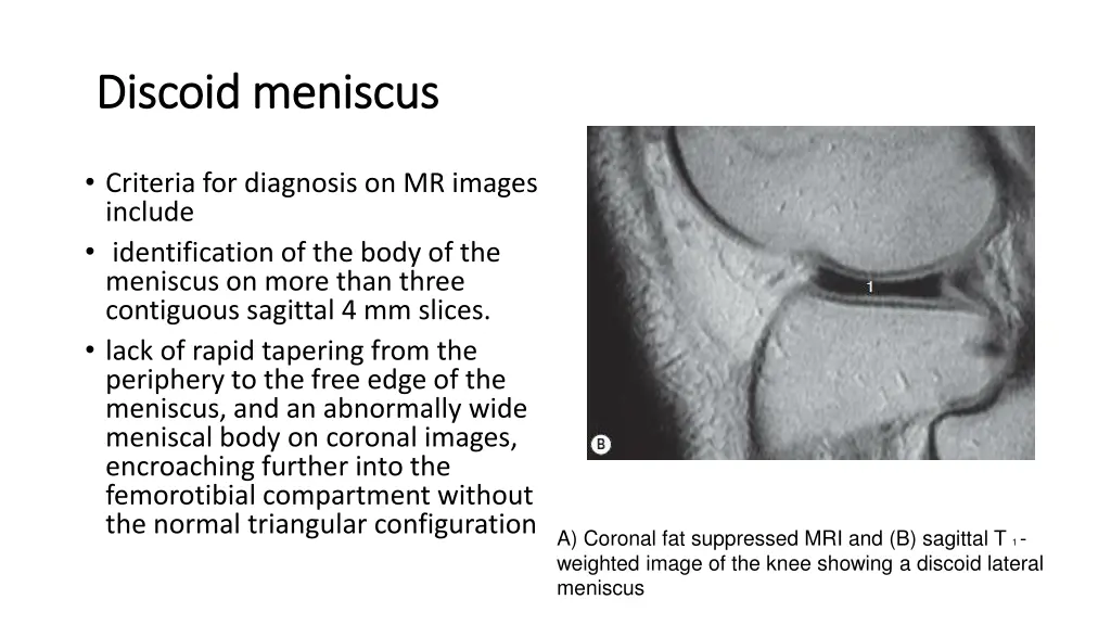 discoid meniscus discoid meniscus