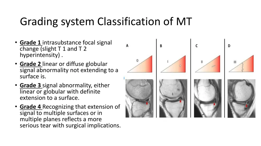 grading system classification of mt