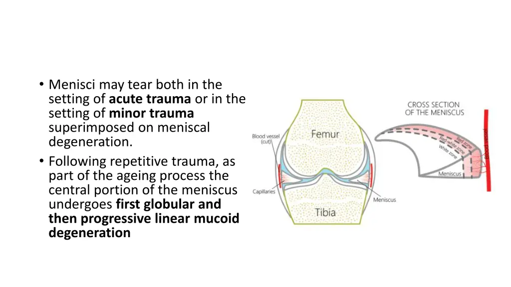 menisci may tear both in the setting of acute