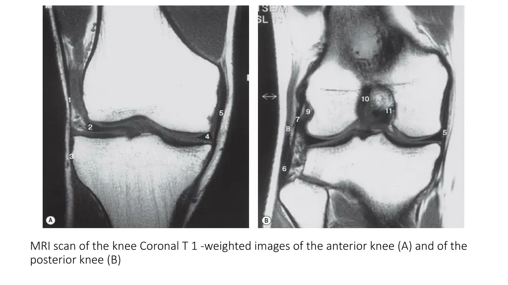 mri scan of the knee coronal t 1 weighted images