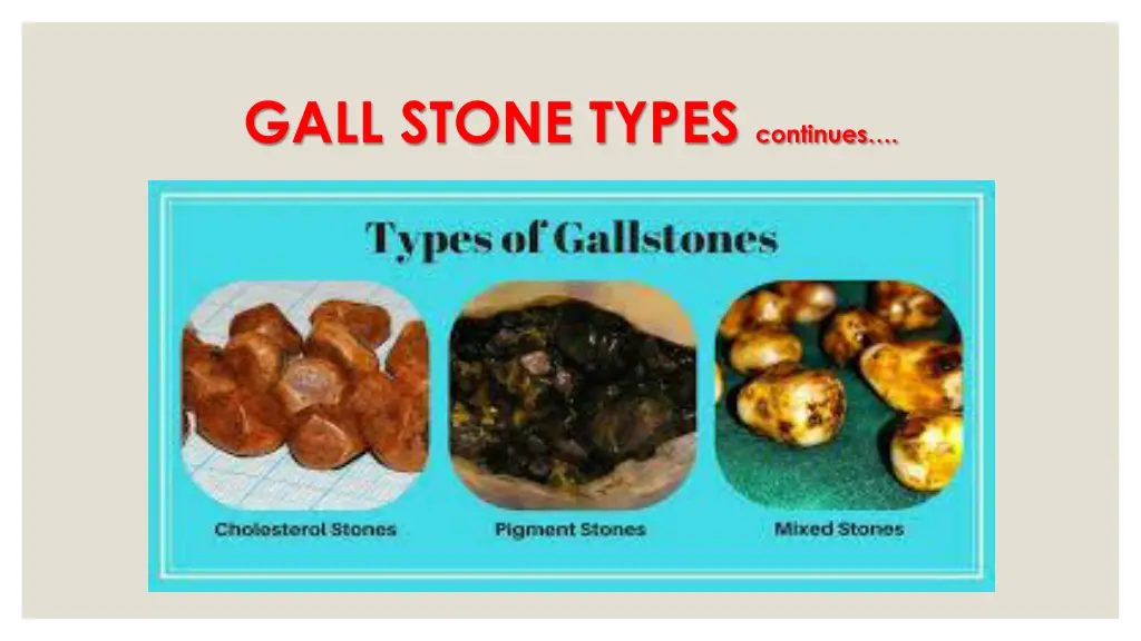 gall stone types continues