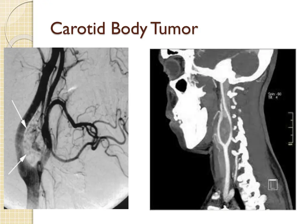 carotid body tumor 6