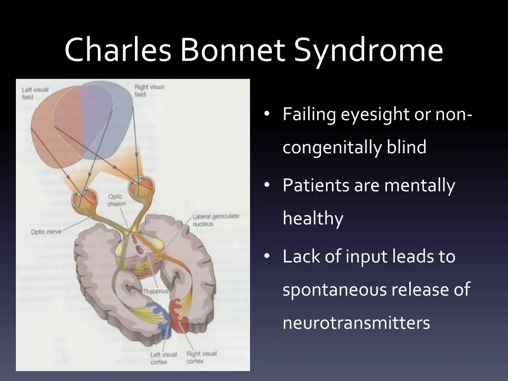 charles bonnet syndrome