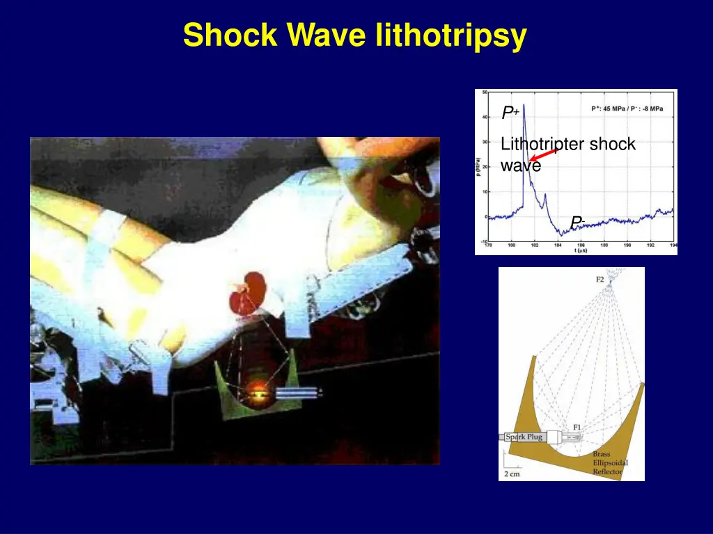 shock wave lithotripsy