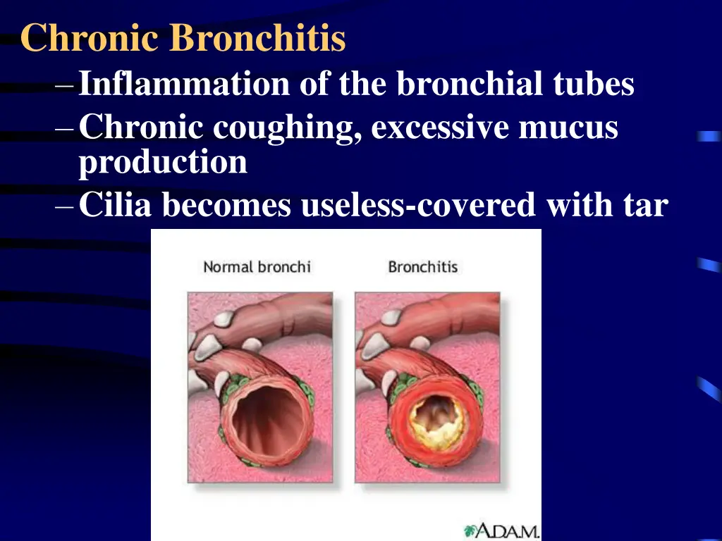 chronic bronchitis inflammation of the bronchial