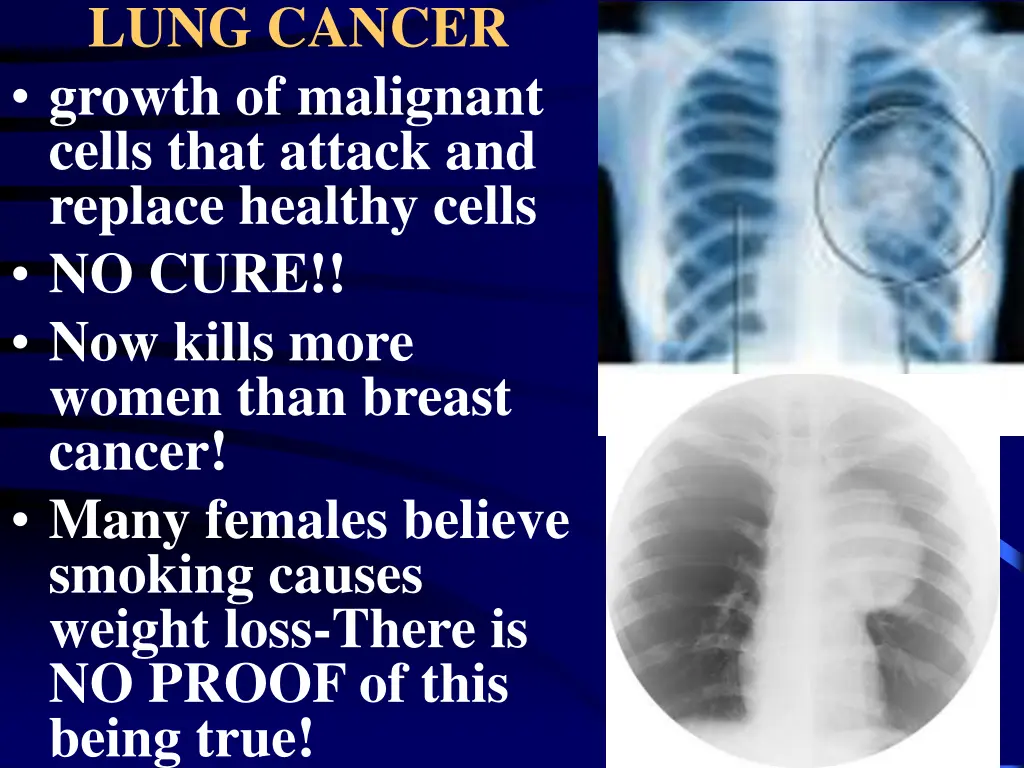 lung cancer growth of malignant cells that attack