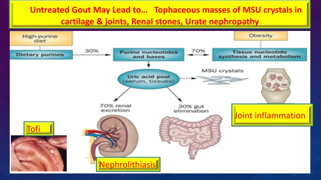 untreated gout may lead to tophaceous masses