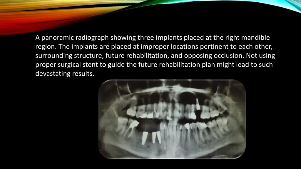 a panoramic radiograph showing three implants