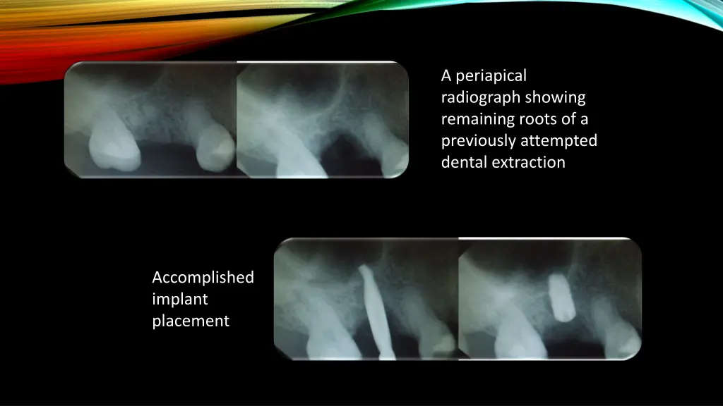 a periapical radiograph showing remaining roots