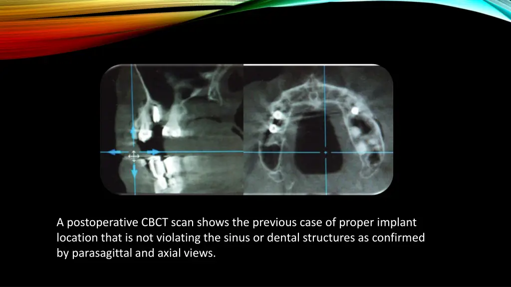 a postoperative cbct scan shows the previous case