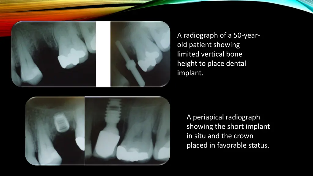 a radiograph of a 50 year old patient showing