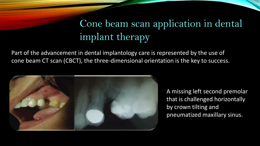 cone beam scan application in dental implant