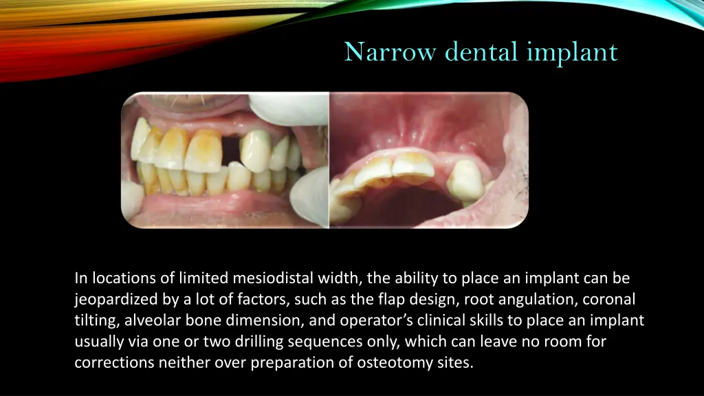 narrow dental implant