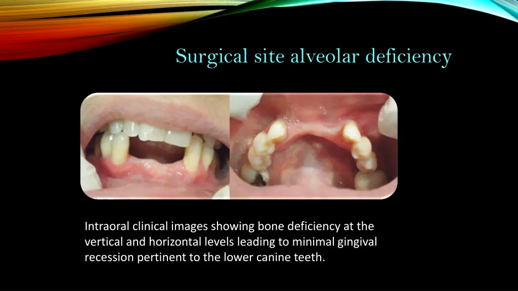 surgical site alveolar deficiency