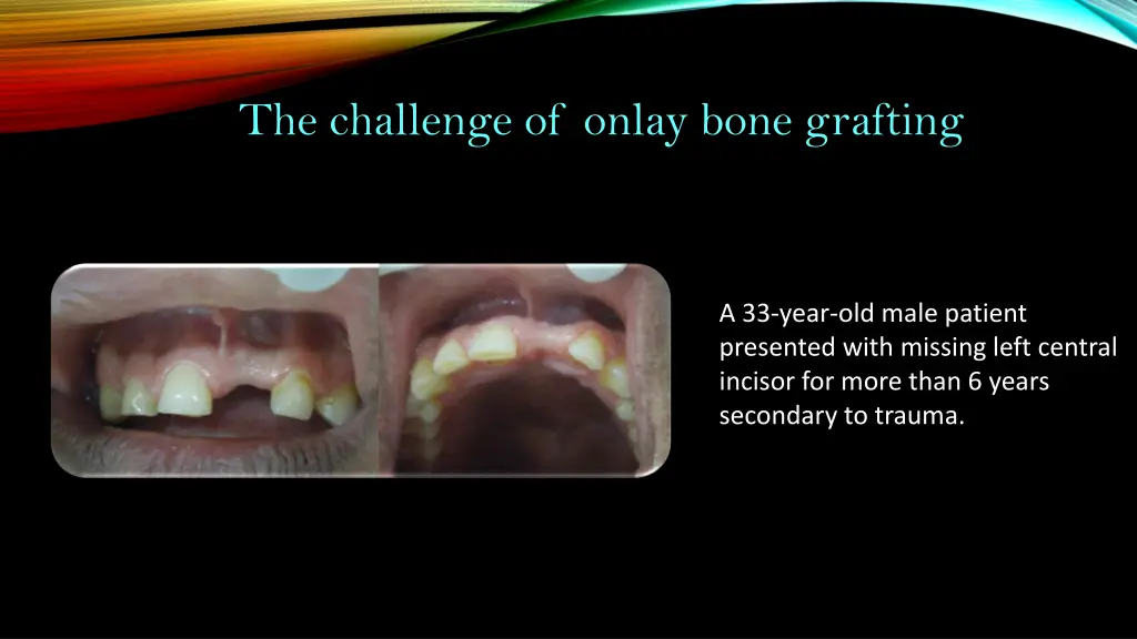 the challenge of onlay bone grafting