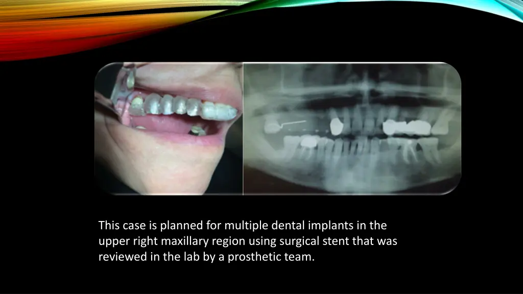 this case is planned for multiple dental implants