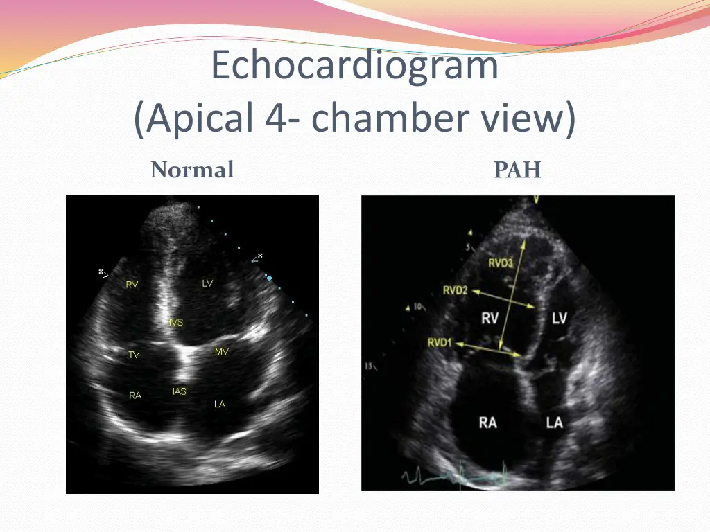 echocardiogram apical 4 chamber view