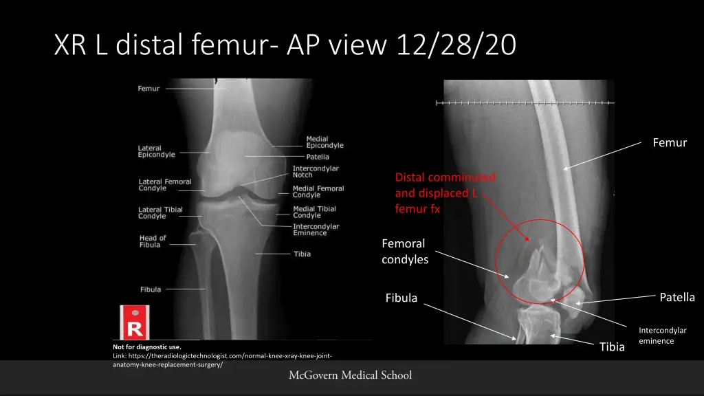 xr l distal femur ap view 12 28 20