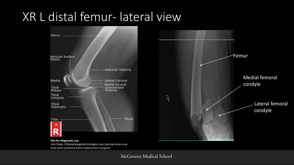 xr l distal femur lateral view