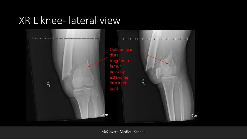 xr l knee lateral view