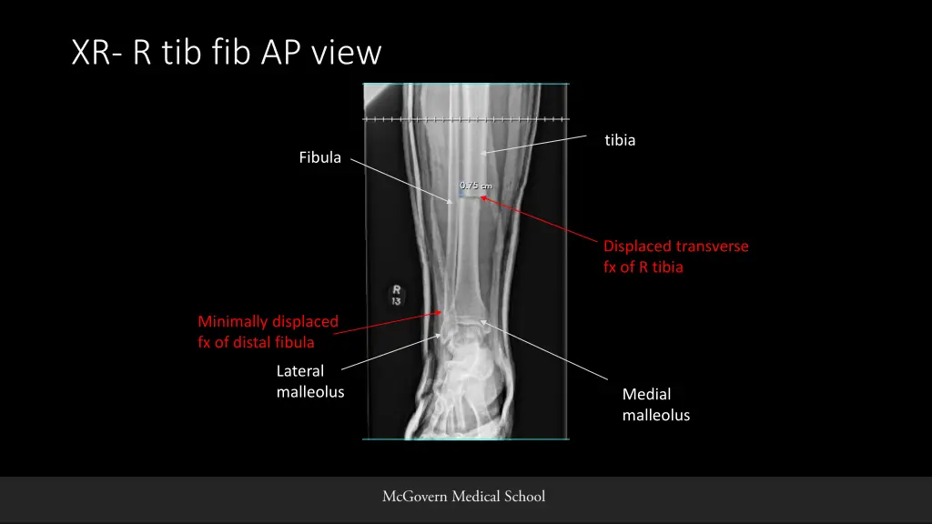 xr r tib fib ap view