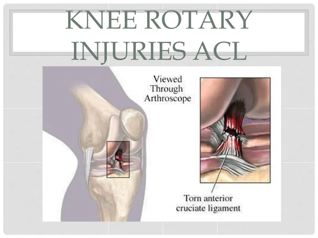 knee rotary injuries acl