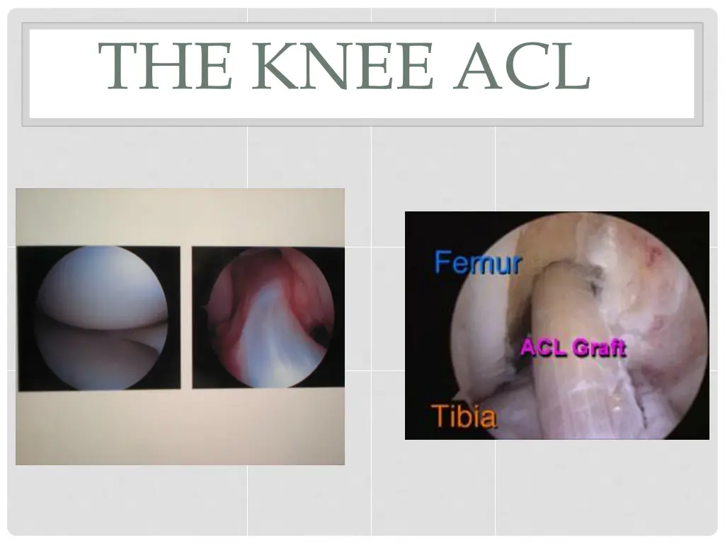 the knee acl