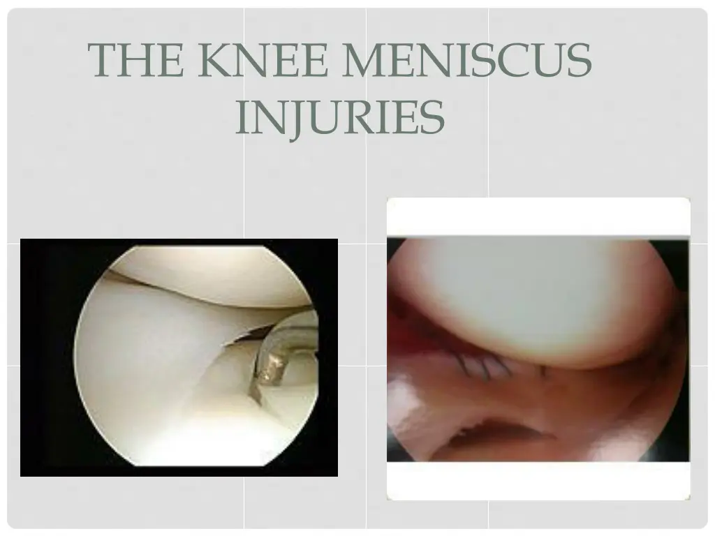 the knee meniscus injuries 1