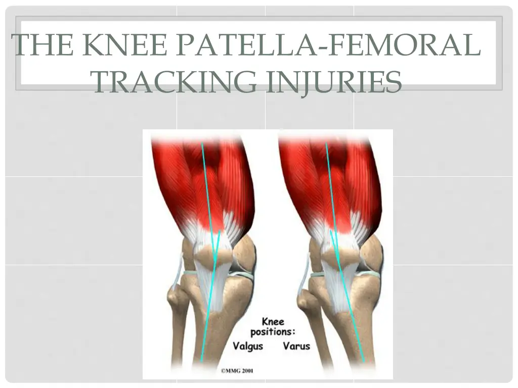 the knee patella femoral tracking injuries