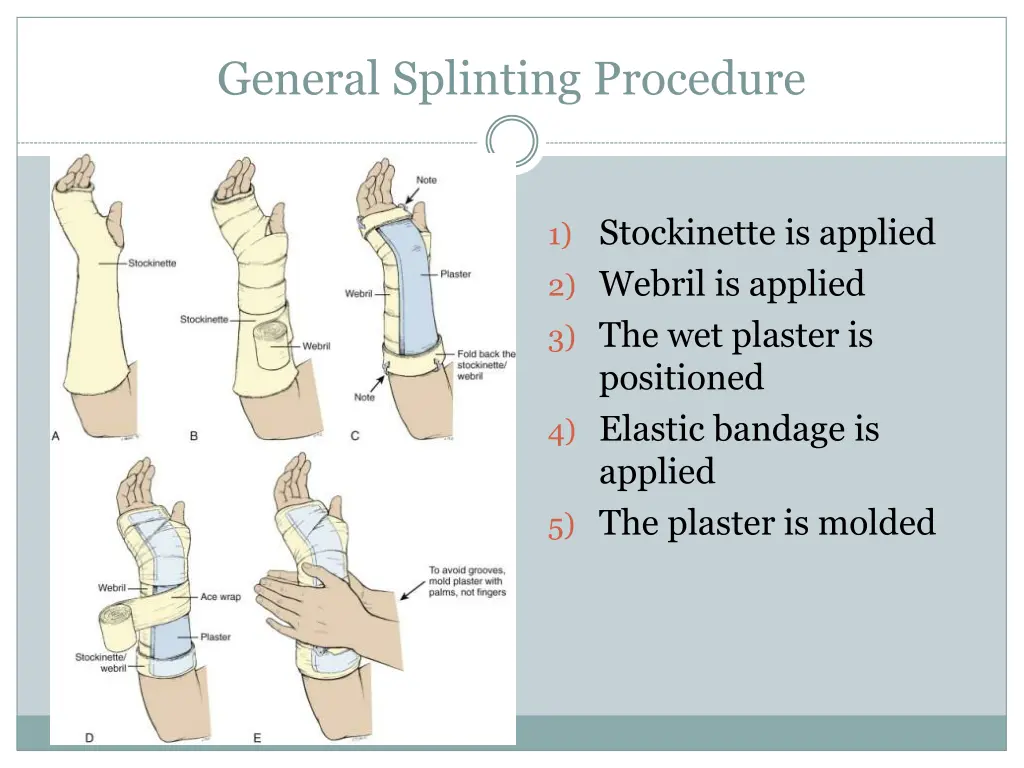 general splinting procedure